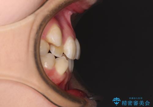 八重歯と正中のズレ ワイヤー装置での抜歯矯正の治療前