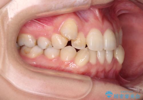 八重歯と正中のズレ ワイヤー装置での抜歯矯正の治療前