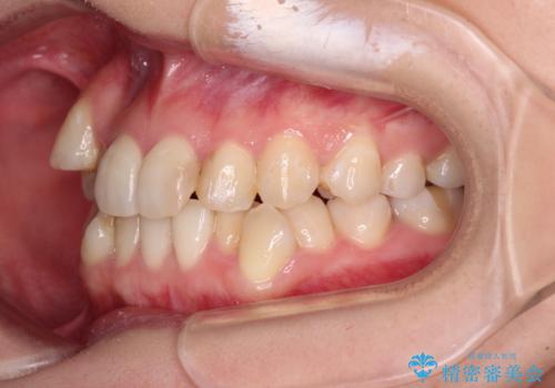 八重歯と正中のズレ ワイヤー装置での抜歯矯正の治療前
