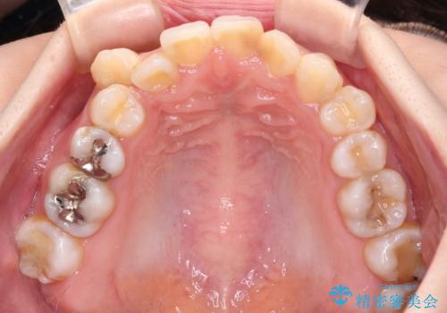 八重歯と正中のズレ ワイヤー装置での抜歯矯正の治療前