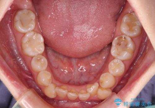 八重歯と正中のズレ ワイヤー装置での抜歯矯正の治療前