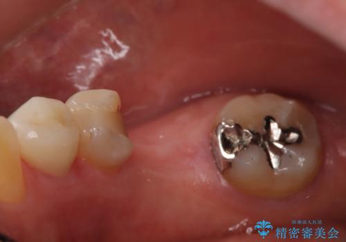 奥歯で食事をしたい インプラントとノンクラスプデンチャーによる治療の治療前