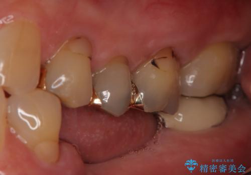 奥歯で食事をしたい インプラントとノンクラスプデンチャーによる治療の治療前