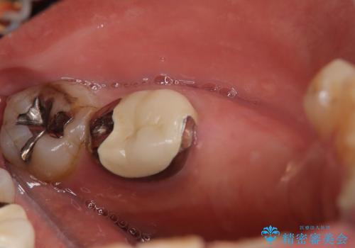 奥歯で食事をしたい インプラントとノンクラスプデンチャーによる治療の治療前