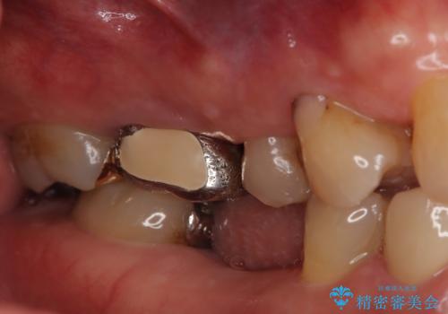 奥歯で食事をしたい インプラントとノンクラスプデンチャーによる治療の治療前