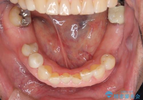 根管治療&矯正歯科治療の症例 治療前