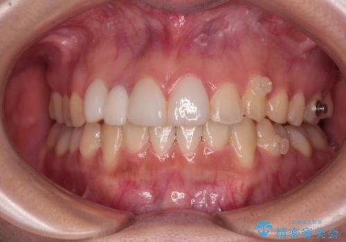 前歯のデコボコが気になる　インビザラインによる矯正治療の治療中