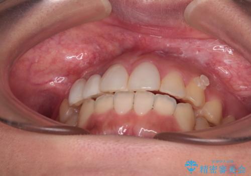 前歯のデコボコが気になる インビザラインによる矯正治療の治療中