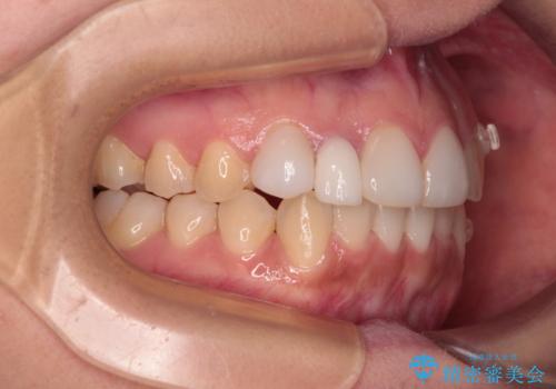 前歯のデコボコが気になる インビザラインによる矯正治療の治療中