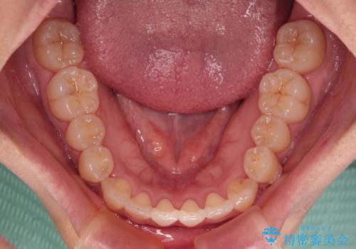 前歯のデコボコが気になる　インビザラインによる矯正治療の治療中