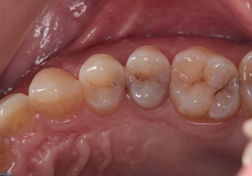 虫歯をランクの高い材料で治したい セラミックインレーの症例 治療前