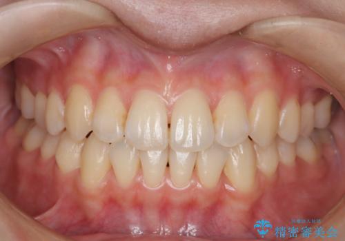 前歯のガタつき、下顎の前突感を治したい インビザライン矯正例の症例 治療後