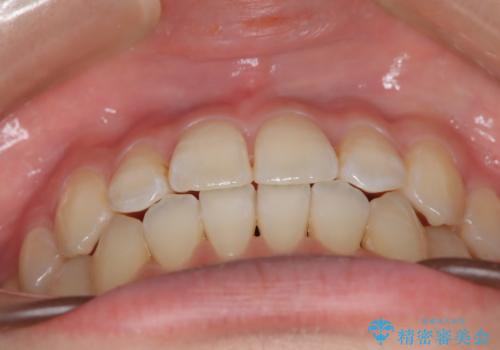 前歯のガタつき、下顎の前突感を治したい インビザライン矯正例の治療後
