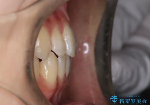 前歯のガタつき、下顎の前突感を治したい インビザライン矯正例の治療後