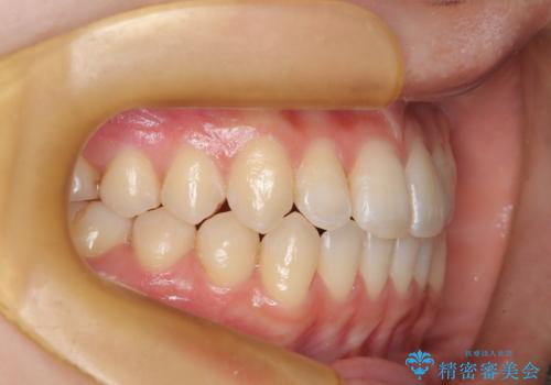 前歯のガタつき、下顎の前突感を治したい インビザライン矯正例の治療後