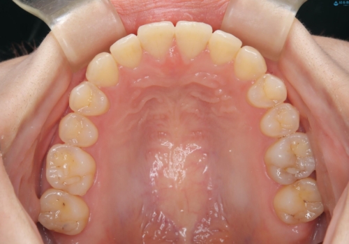 前歯のガタつき、下顎の前突感を治したい インビザライン矯正例の治療後