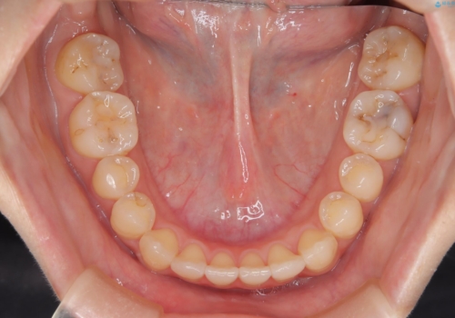 前歯のガタつき、下顎の前突感を治したい　インビザライン矯正例の治療後