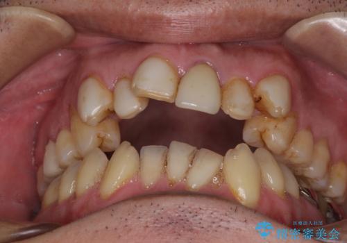 外科手術を検討? 過大な開咬をワイヤー装置とインビザラインで劇的に改善する