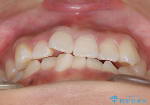 ワイヤー矯正で確実にガタつきを治したい セラミックブラケットによる治療の治療前