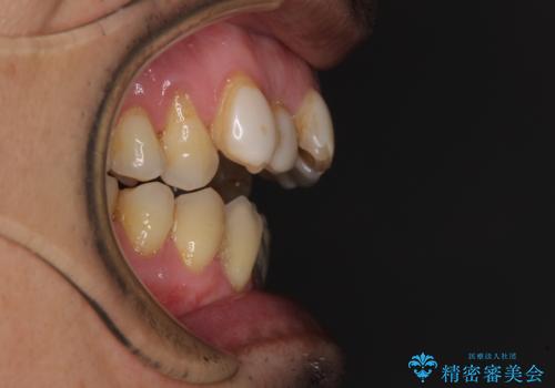 外科手術を検討? 過大な開咬をワイヤー装置とインビザラインで劇的に改善するの治療前
