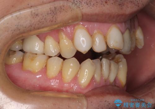 外科手術を検討? 過大な開咬をワイヤー装置とインビザラインで劇的に改善するの治療前