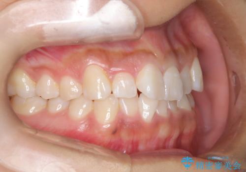 ワイヤー矯正で確実にガタつきを治したい セラミックブラケットによる治療の治療前