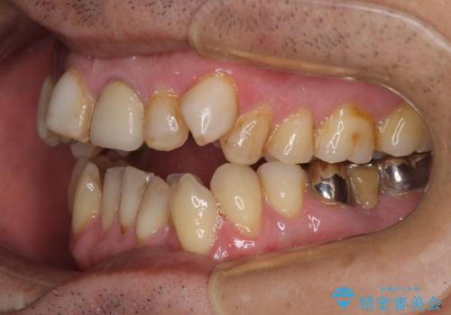 外科手術を検討? 過大な開咬をワイヤー装置とインビザラインで劇的に改善するの治療前