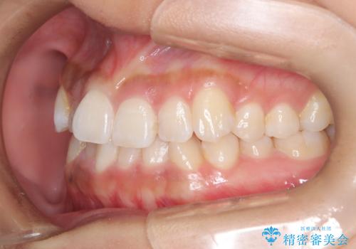 ワイヤー矯正で確実にガタつきを治したい セラミックブラケットによる治療の治療前