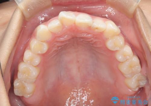 ワイヤー矯正で確実にガタつきを治したい セラミックブラケットによる治療の治療前
