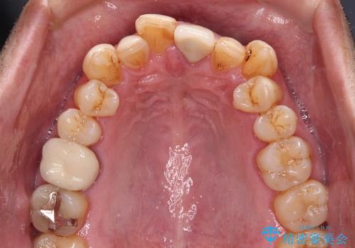 外科手術を検討? 過大な開咬をワイヤー装置とインビザラインで劇的に改善するの治療前