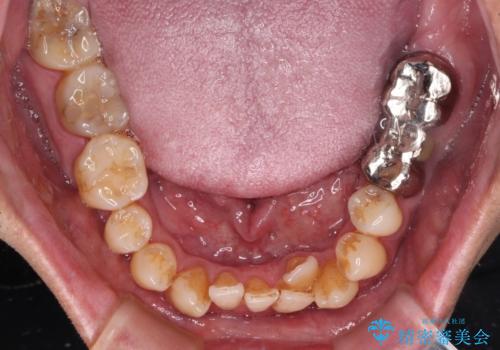 外科手術を検討? 過大な開咬をワイヤー装置とインビザラインで劇的に改善するの治療前