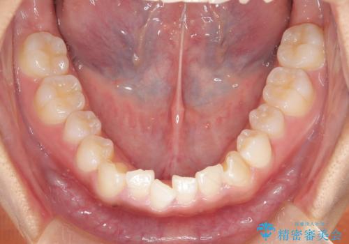 ワイヤー矯正で確実にガタつきを治したい セラミックブラケットによる治療の治療前