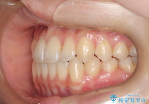 前歯のガタつき、下顎の前突感を治したい インビザライン矯正例の治療後