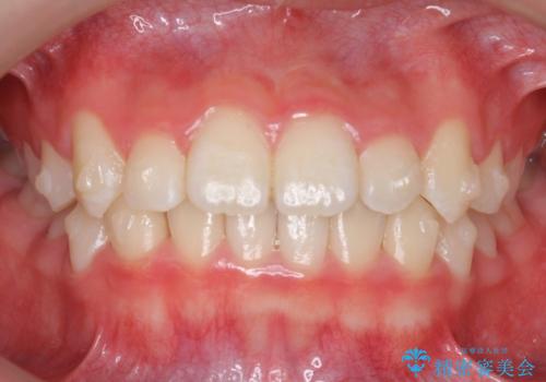 八重歯 歯を抜かずにインビザラインでの治療中
