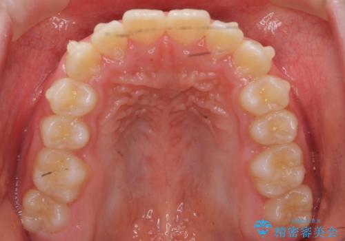 八重歯 歯を抜かずにインビザラインでの治療中