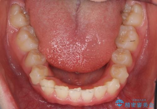 八重歯 歯を抜かずにインビザラインでの治療中