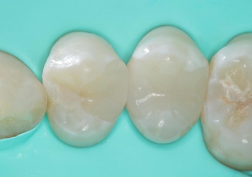 虫歯をランクの高い材料で治したい セラミックインレーの治療中