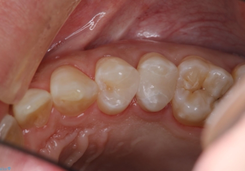 虫歯をランクの高い材料で治したい　セラミックインレーの治療後