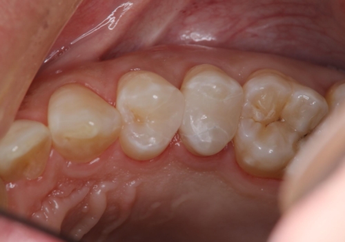 虫歯をランクの高い材料で治したい セラミックインレーの症例 治療後