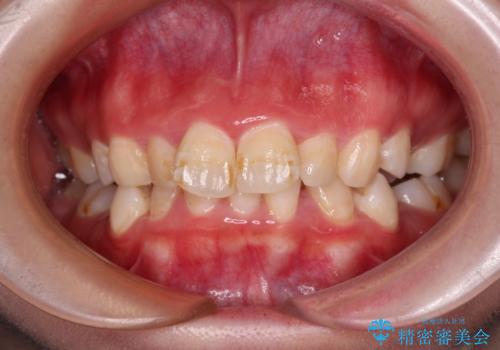 叢生・ディープバイト・突出 ワイヤー装置での抜歯矯正で全てを解決の症例 治療前
