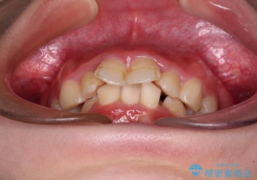 叢生・ディープバイト・突出 ワイヤー装置での抜歯矯正で全てを解決の治療前