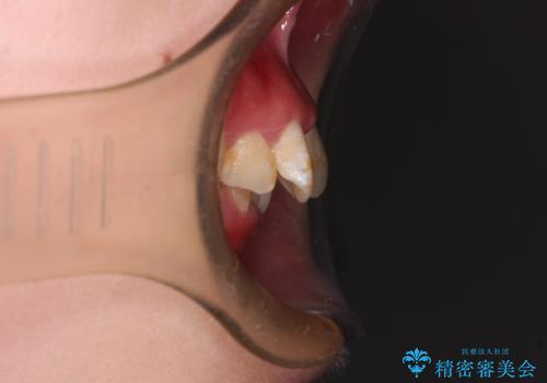 叢生・ディープバイト・突出　ワイヤー装置での抜歯矯正で全てを解決の治療前