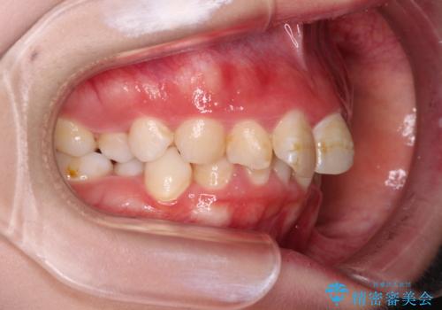 叢生・ディープバイト・突出 ワイヤー装置での抜歯矯正で全てを解決の治療前