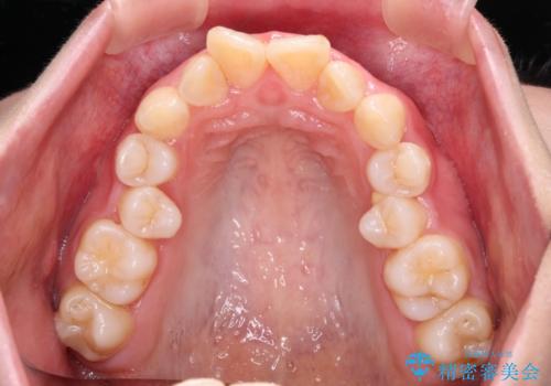 叢生・ディープバイト・突出 ワイヤー装置での抜歯矯正で全てを解決の治療前