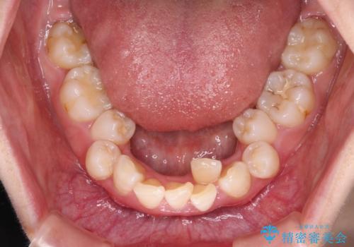 叢生・ディープバイト・突出 ワイヤー装置での抜歯矯正で全てを解決の治療前