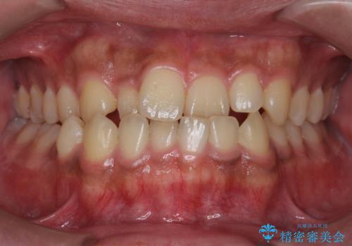 骨格性の受け口　非抜歯で下の歯を後ろに下げる　インビザラインで　インプラント矯正の症例 治療前
