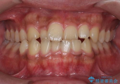 骨格性の受け口　非抜歯で下の歯を後ろに下げる　インビザラインで　<span class=