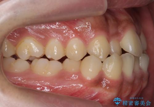 骨格性の受け口　非抜歯で下の歯を後ろに下げる　インビザラインで　インプラント矯正