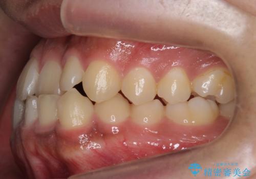 骨格性の受け口　非抜歯で下の歯を後ろに下げる　インビザラインで　インプラント矯正の治療前