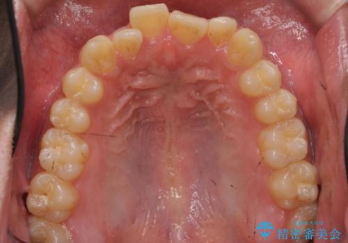 骨格性の受け口 非抜歯で下の歯を後ろに下げる インビザラインで インプラント矯正の治療前